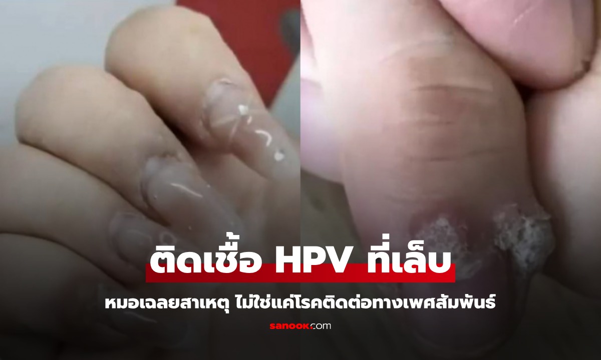 สาวทำเล็บติดเชื้อ HPV นิ้วเป็นหูดดอกกะหล่ำ หมอเฉลยสาเหตุ ไม่ใช่โรคติดต่อทางเพศ