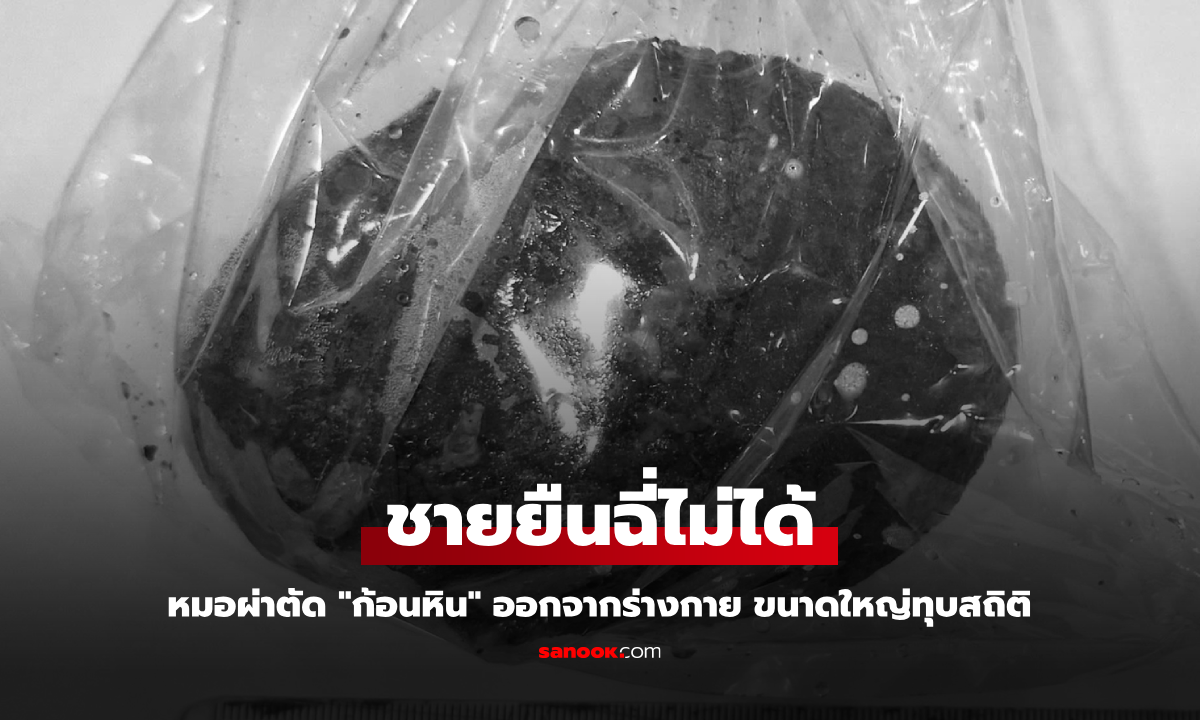 ชายยืนฉี่ไม่ได้ หมอผ่าตัด "ก้อนหิน" ออกจากร่างกาย ขนาดใหญ่ทุบสถิติที่ รพ. เคยเจอมา