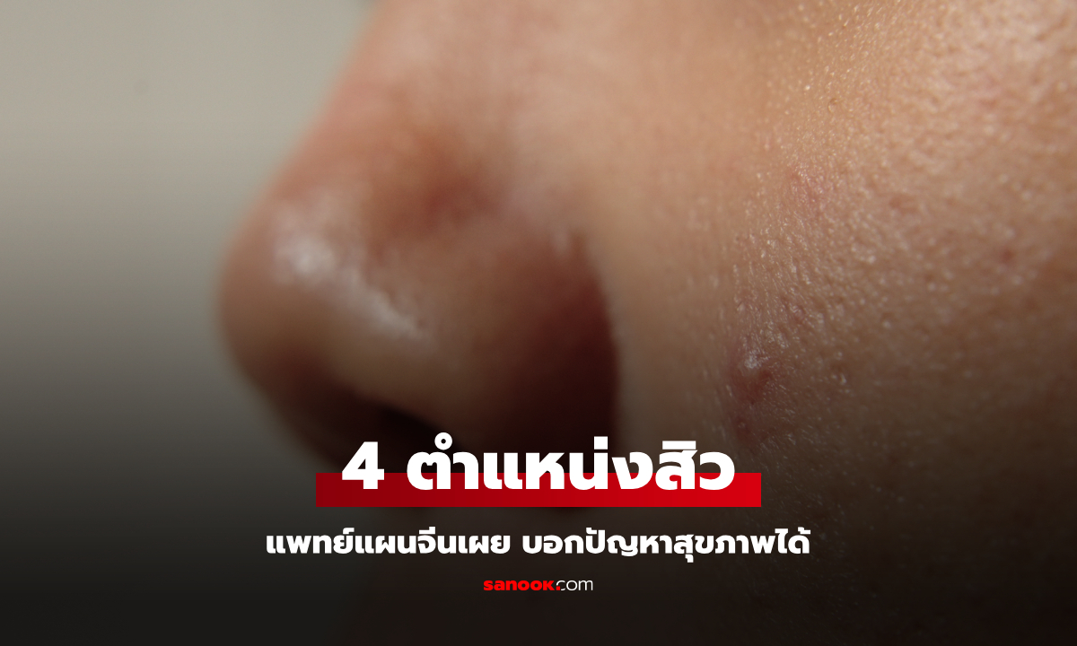 แพทย์แผนจีนเผย สิวขึ้น 4 ตำแหน่งนี้ บอกปัญหาสุขภาพภายใน หัวใจ ตับ ไต ระบบย่อย