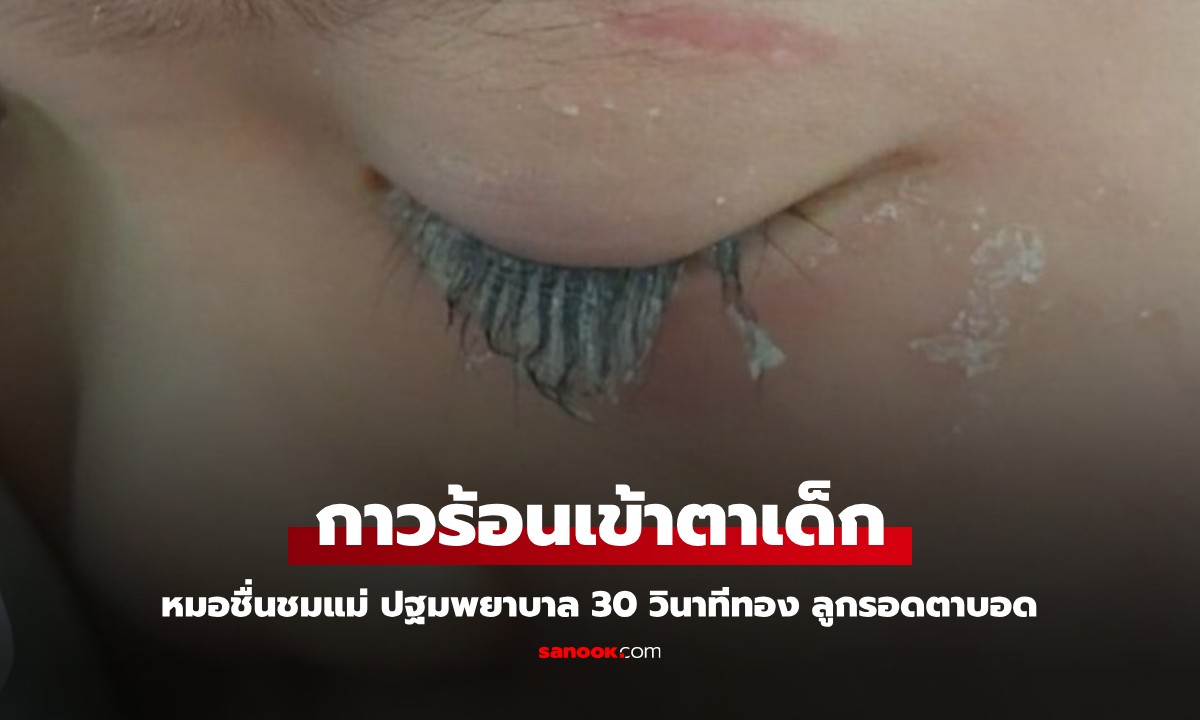 กาวร้อนเข้าตาเด็ก 3 ขวบ หมอชื่นชมแม่ ปฐมพยาบาล 30 วินาทีทอง ช่วยลูกรอดตาบอด