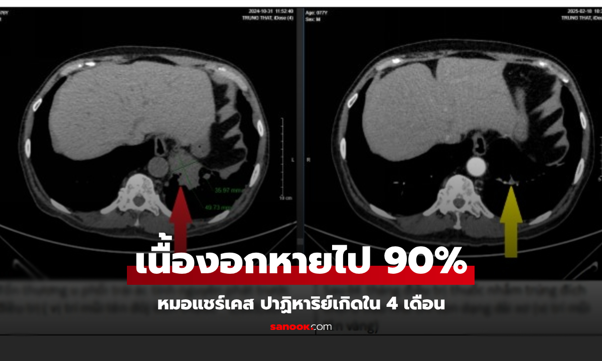 ราวปาฏิหาริย์ ชายป่วยมะเร็ง "ระยะสุดท้าย" ทำตามหมอแนะ 4 เดือน เนื้องอกหายไป 90%