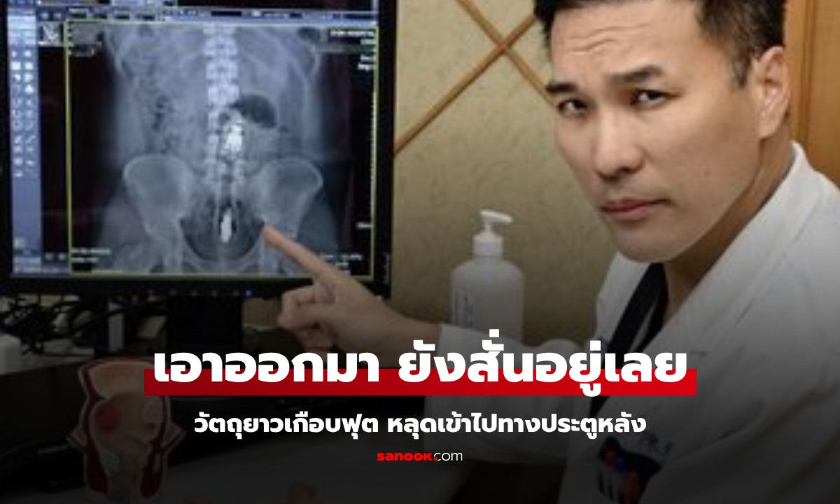 หนุ่มสารภาพกับหมอ เพิ่ง "เล่นพิเรนท์" กับแฟน X-Ray เจอแท่งยาวคาลำไส้ ยังสั่นอยู่เลย!