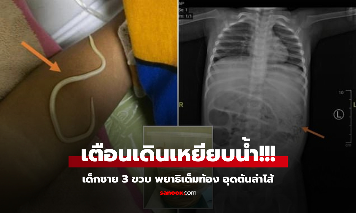 ภาพสยอง ดึงพยาธิตัวเป้ง ออกจากร่างเด็กชาย 3 ขวบ หมอรีบเตือนเรื่อง "เดินเหยียบน้ำ"