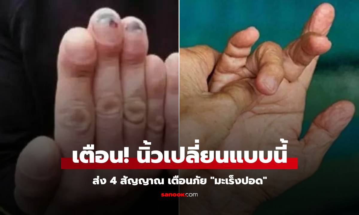 รู้ไว้ดีกว่า 4 ความเปลี่ยนแปลงที่ "ปลายนิ้ว" อาจเป็นสัญญาณมะเร็งปอด ใครมีควรพบแพทย์!