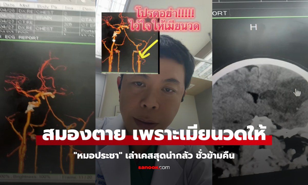 หมอประชา เล่าเคสสามี "สมองตาย" แขนขาอ่อนแรง หลังให้ภรรยา "นวดคอ" คลายเมื่อย