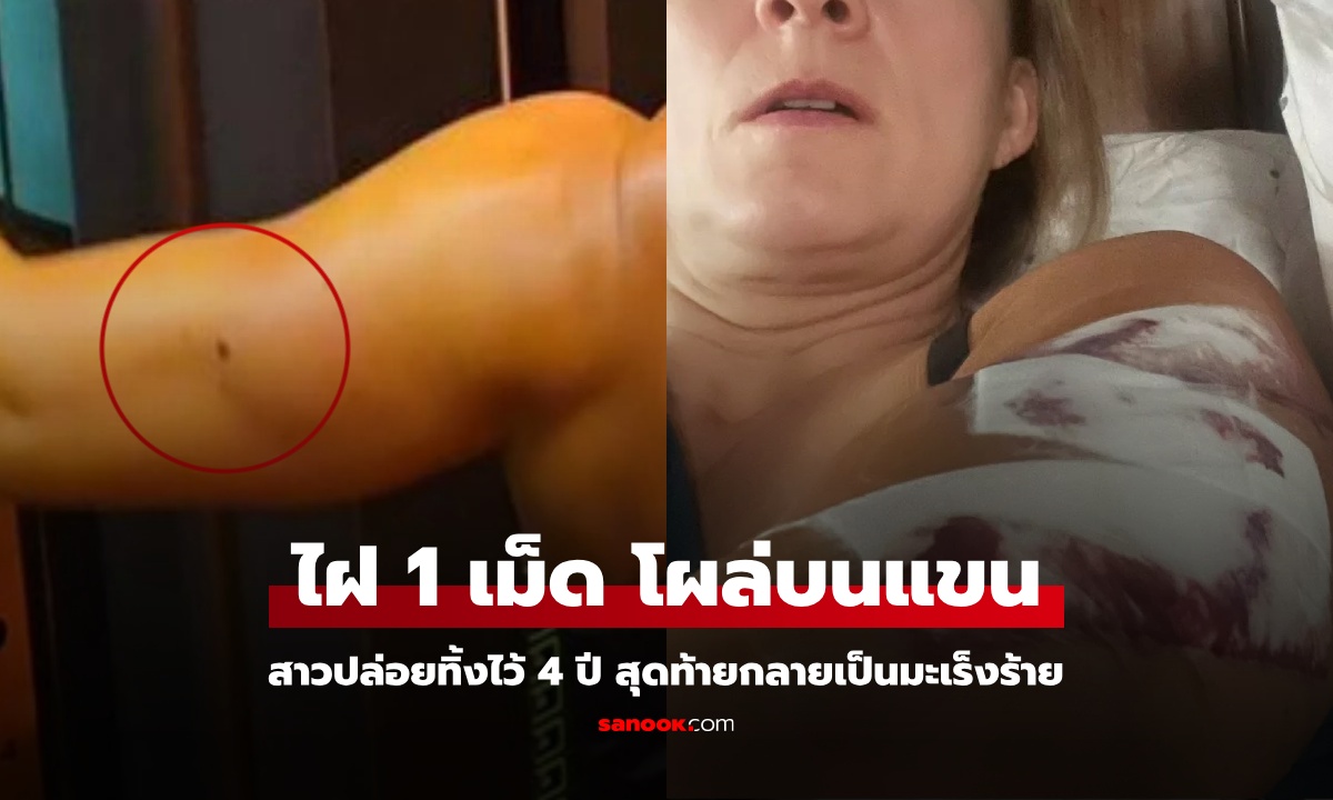ไฝ 1 เม็ด โผล่บนแขน สาวปล่อยทิ้งไว้ 4 ปี สุดท้ายกลายเป็นมะเร็ง ผ่าตัดใหญ่เย็บ 77 เข็ม