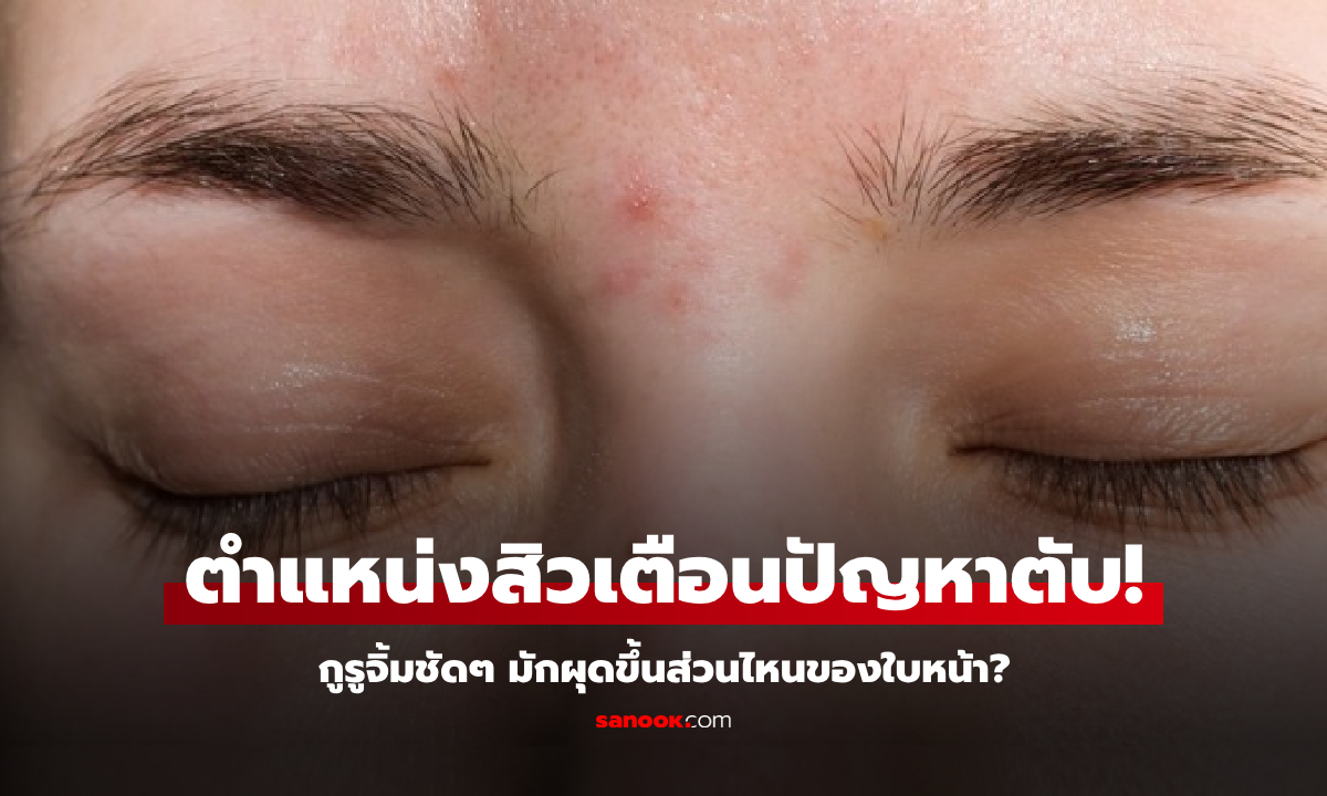 เพิ่งจะรู้! ผู้เชี่ยวชาญจิ้มชัดๆ "ตำแหน่งสิวเตือนปัญหาตับ" มักผุดขึ้นส่วนไหนของใบหน้า?