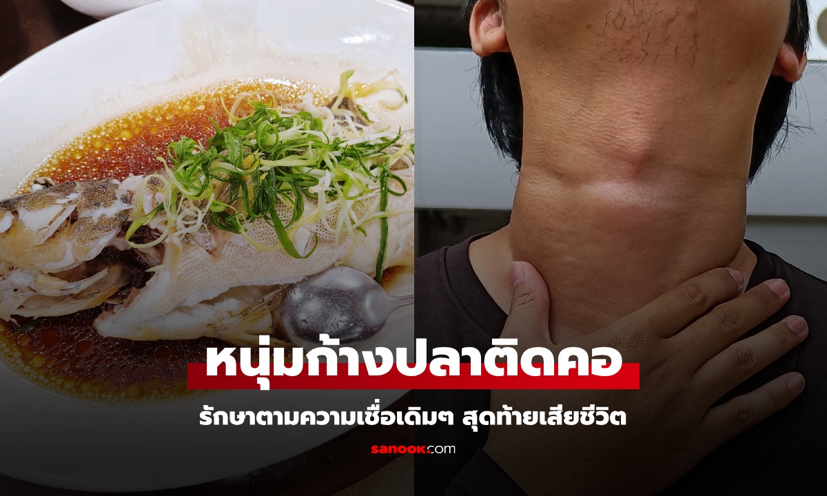 หนุ่มก้างปลาติดคอ รักษาตามความเชื่อเดิมๆ กินน้ำส้มสายชู-กลืนข้าว สุดท้ายเสียชีวิต