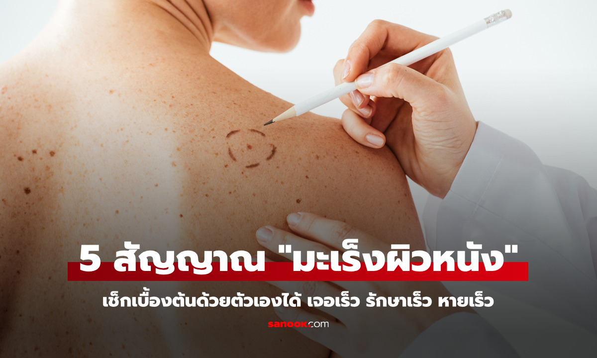 5 สัญญาณอันตราย "มะเร็งผิวหนัง" ที่ไม่ควรมองข้าม