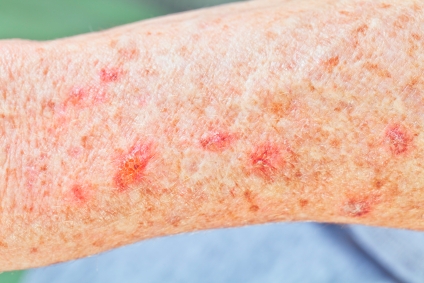 skin-cancer-symptoms