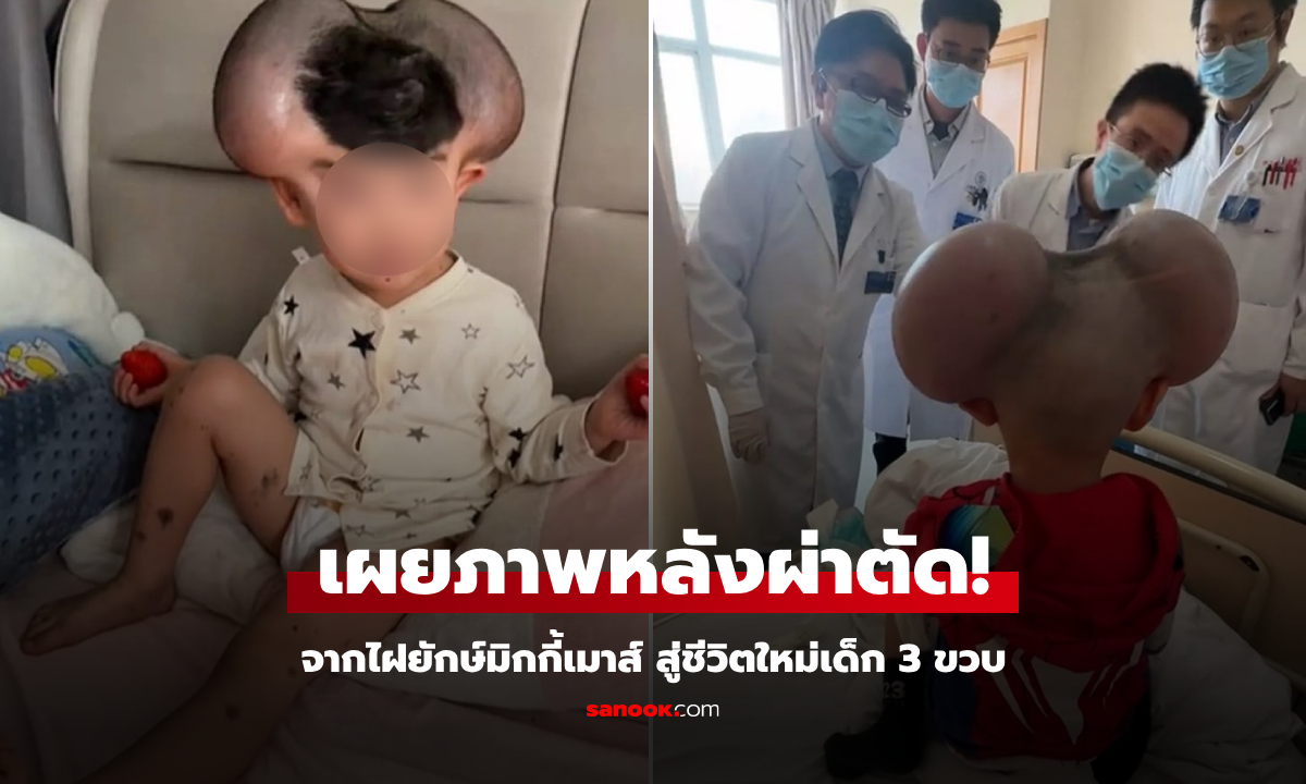 "ไฝยักษ์" หนูน้อย 3 ขวบ โดนล้อหูมิกกี้เมาส์ เผยโฉมหลังผ่าตัดสำเร็จ ใครเห็นก็น้ำตาซึม!