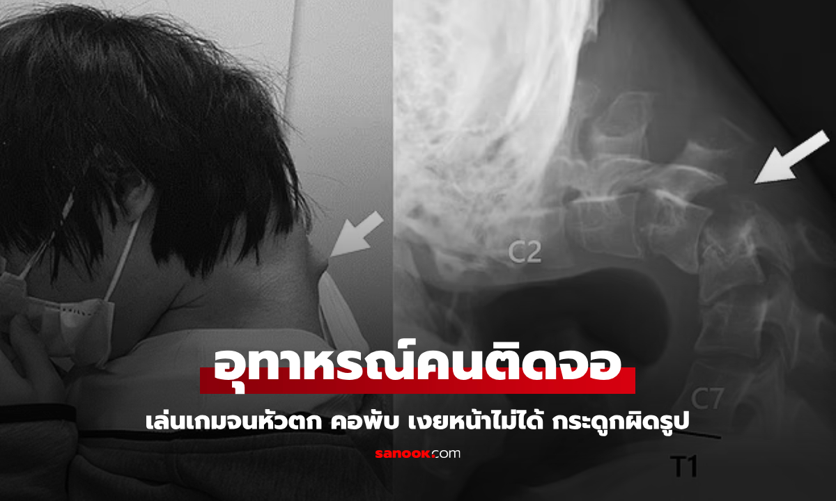 ภาพเอกซเรย์สุดช็อก หนุ่มหัวตก คอพับ เงยหน้าไม่ได้ เตือนพฤติกรรมเล่นมือถือผิดๆ