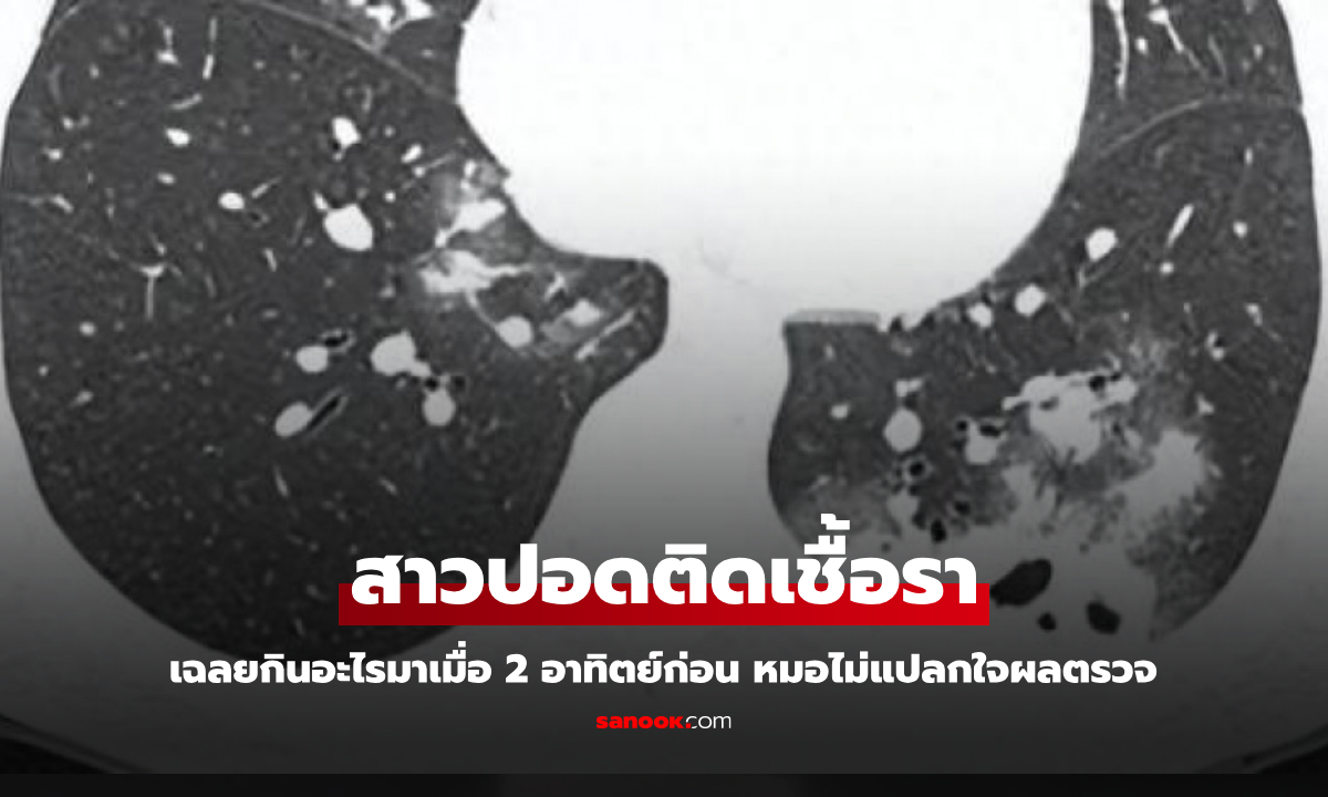 สาวปอดติดเชื้อรา เฉลยกินอะไรมาเมื่อ 2 อาทิตย์ก่อน หมอไม่แปลกใจผลตรวจ