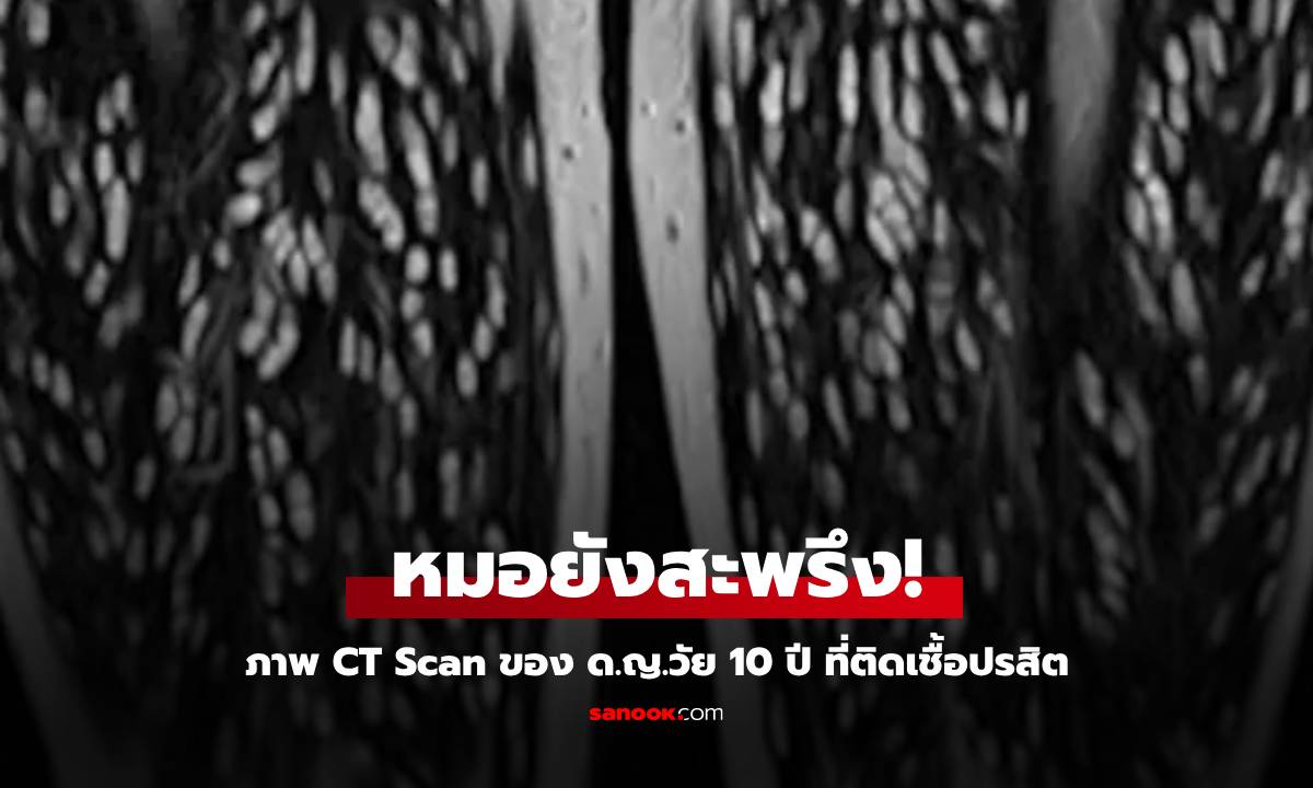 หมอเปิดภาพ CT Scan ที่บ้าที่สุด ด.ญ.วัย 10 ปี ติดเชื้อปรสิตขนาดเมล็ดข้าว
