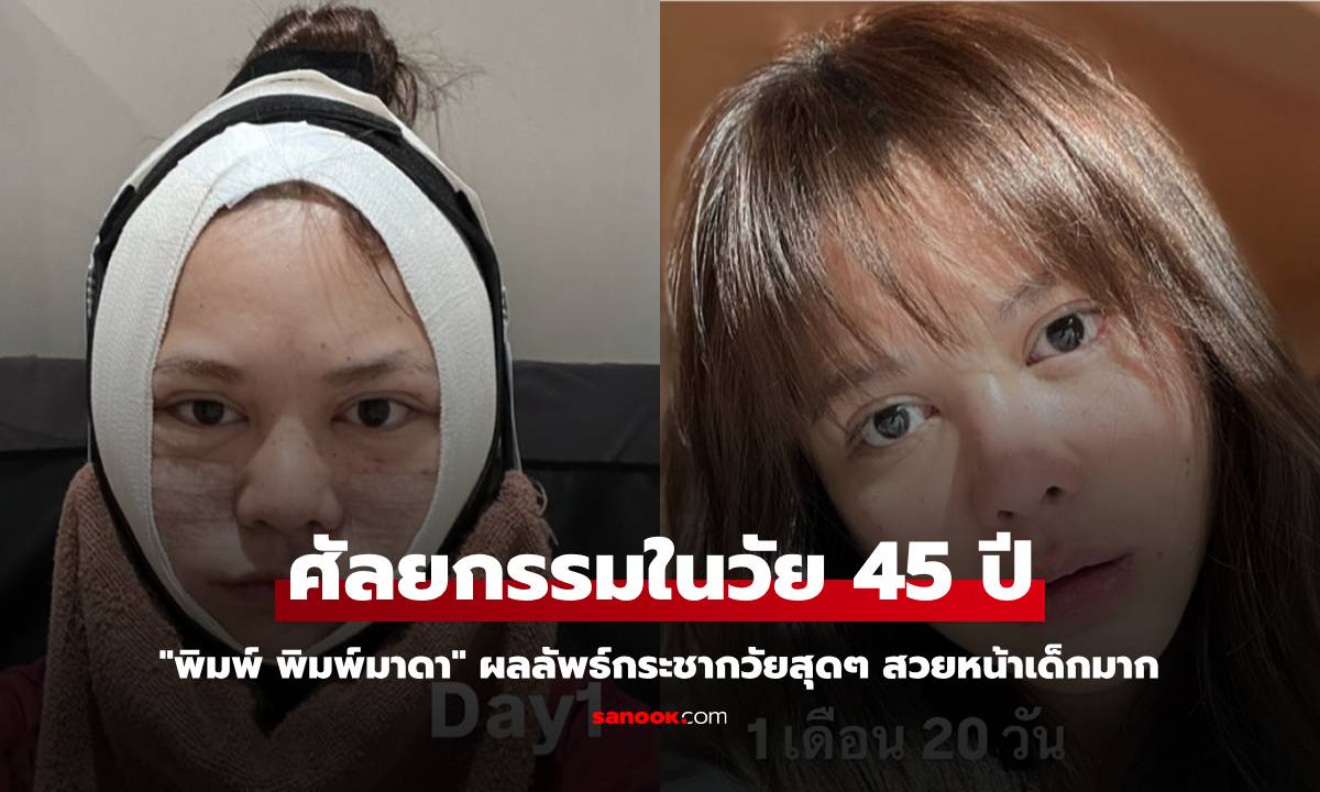 "พิมพ์ พิมพ์มาดา" ศัลยกรรมในวัย 45 ปี ผลลัพธ์กระชากวัยสุดๆ สวยหน้าเด็กมาก