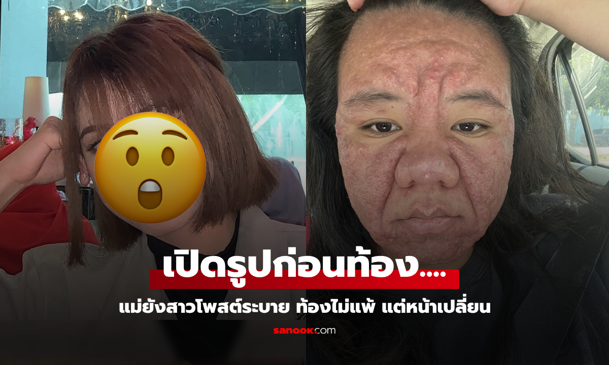 ทำใจยาก! สาวท้องไม่แพ้ แต่หน้าเปลี่ยน 100% สิ้นความมั่นใจ ฝากข้อความถึง "สามี" ทุกคน