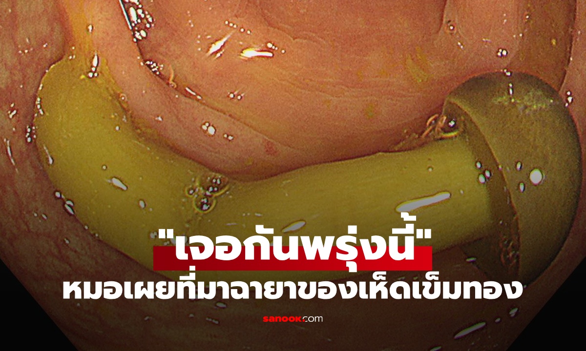 หมอเล่าขำๆ ฉายาของเห็ดเข็มทองคือ "เจอกันพรุ่งนี้" ให้ภาพในลำไส้ใหญ่เป็นคำตอบ