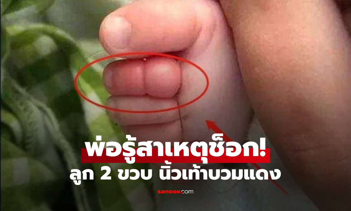 พ่อพาลูก 2 ขวบไปว่ายน้ำ 2 วันต่อมาร้องเจ็บ หวิดโดน "ตัดนิ้วเท้า" หมอชี้ต้นเหตุช็อก!