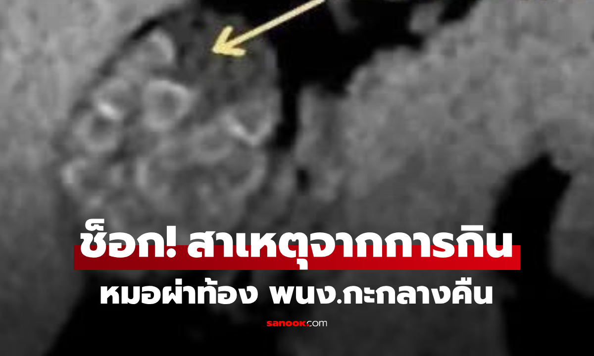 ผ่าท้องหญิง พนง.กะดึก แพทย์สะพรึง "เหมือนเปิดกล่องสุ่มคริสตัล" ขนลุกสาเหตุจากการกิน!!!