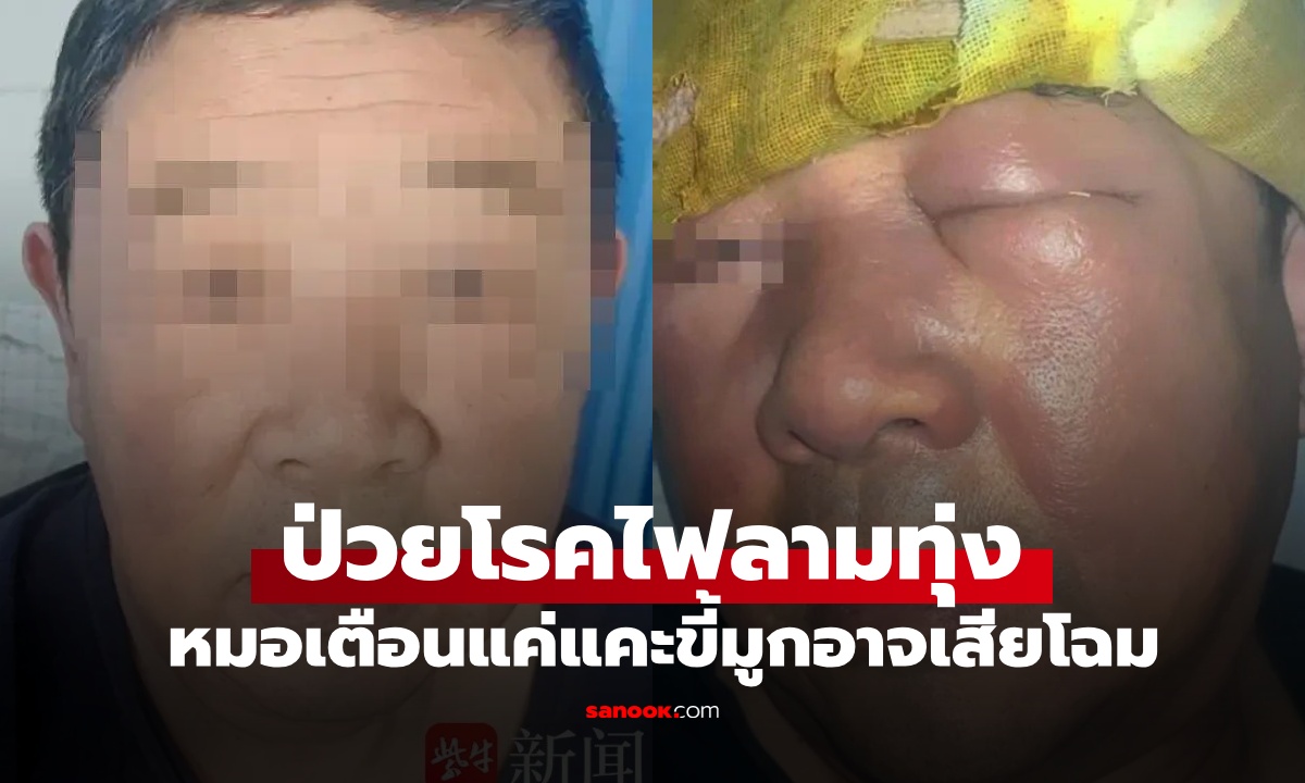 ชายป่วยโรค "ไฟลามทุ่ง" หน้าบวมสุดทรมาน หมอเตือนแค่ "แคะขี้มูก" อาจถึงขั้นเสียโฉม