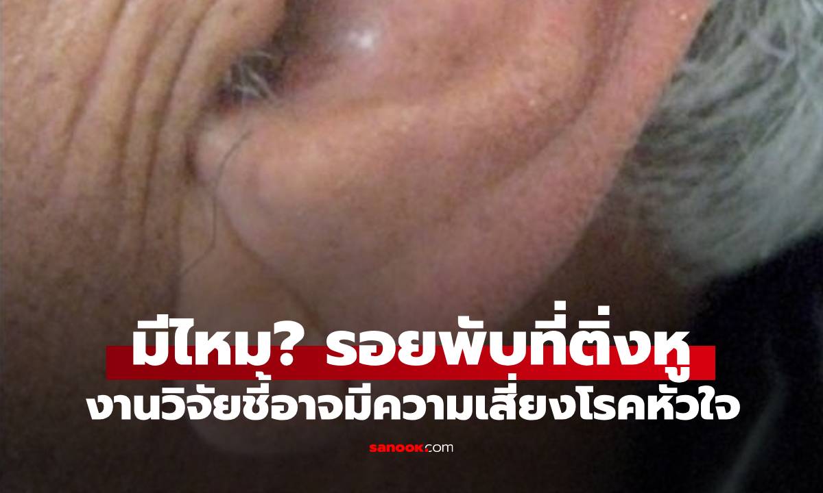 งานวิจัย เผย "รอยพับ" ที่ติ่งหู อาจเป็นสัญญาณเตือน บ่งบอกความเสี่ยงของโรคหัวใจ