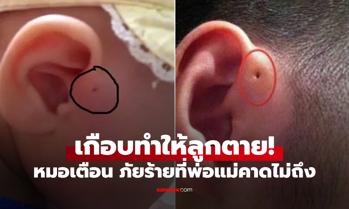 เด็กอนุบาลเกือบตาย! แม่บีบ "รูใกล้หูลูก" ที่ย่าเชื่อเป็นลางดี ช็อกต้องผ่าตัดด่วน หมอชี้คืออะไร?