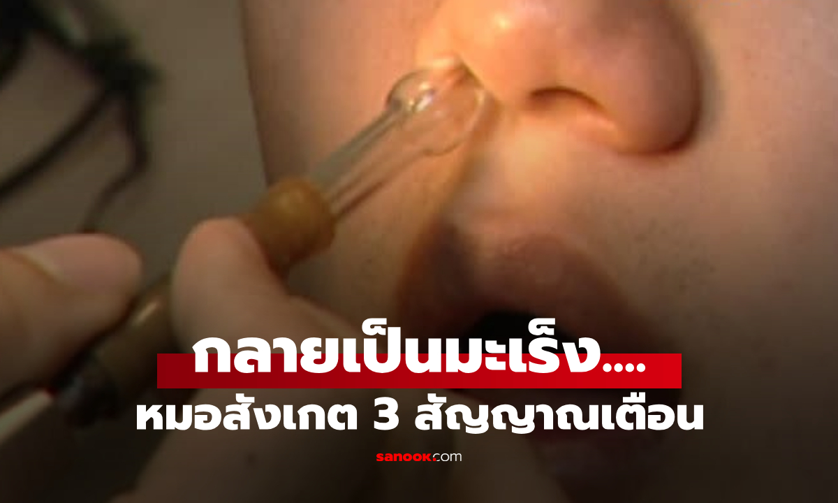 ชายคัดจมูกไม่หาย หมอสังเกต 3 อาการ ส่งตรวจ "มะเร็ง" เป็นจริง เตือนทุกคนเช็กตามนี้!