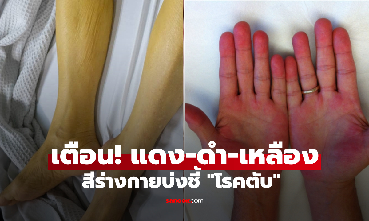 เมื่อ &quot;โรคตับ&quot; ร้องให้ช่วยผ่านผิวหนัง เห็น 3 อาการ แดง-ดำ-เหลือง ตามนี้ รีบพบแพทย์ให้ทัน!" width="100" height="100