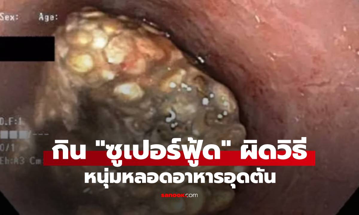 หนุ่มกิน "ซูเปอร์ฟู้ด" ยอดนิยมจนหลอดอาหารอุดตัน ดีต่อสุขภาพจริง แต่ต้องกินให้ถูกวิธี