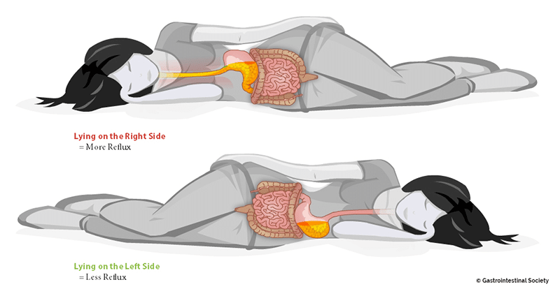 reflux_sleep-with-captions