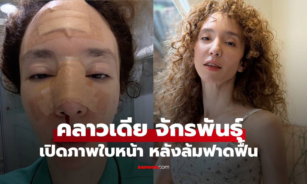 "คลาวเดีย จักรพันธุ์" เปิดภาพใบหน้า หลังล้มฟาดฟื้น เห็นแล้วเจ็บปวดแทนเลย