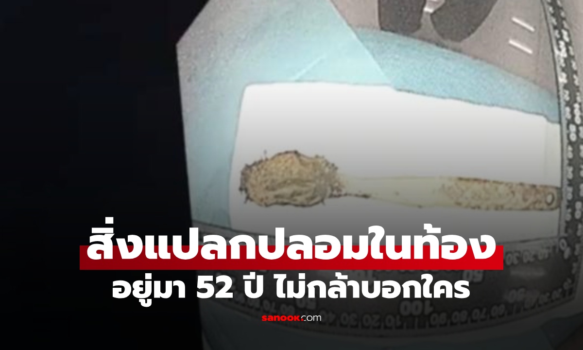 ชายชราเจ็บหน้าอกเรื้อรัง หมออึ้งต้นเหตุ "สิ่งแปลกปลอม" อยู่ในร่างกายมานาน 52 ปี