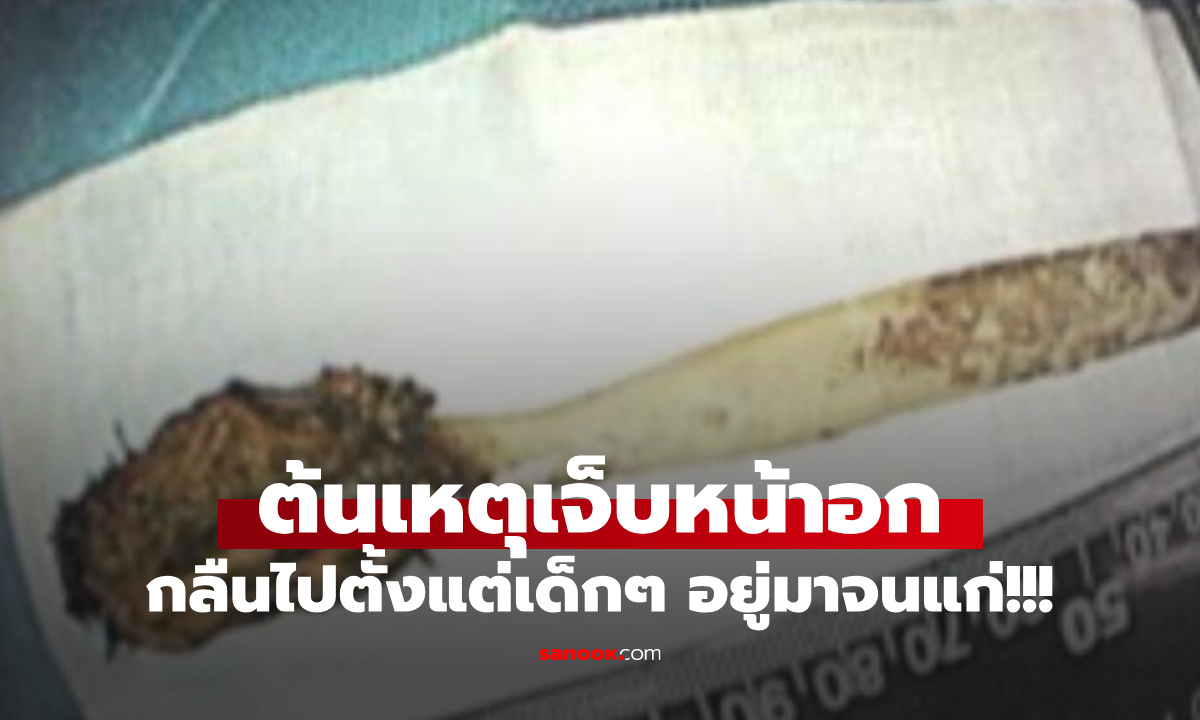 หมอช็อก! ชายเจ็บหน้าอก ส่องกล้องเจอ "ของใช้" ไม่ใช่ของกิน แต่ซนกลืนลงไป 52 ปีก่อน