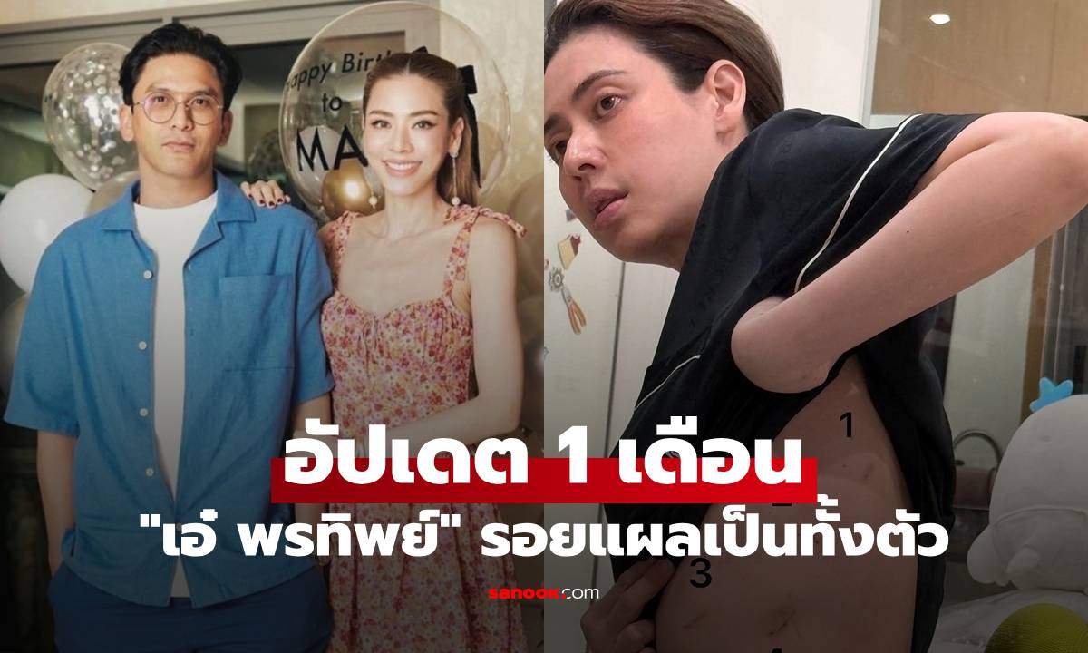 "เอ๋ พรทิพย์" 1 เดือน รอยแผลทั้งตัว "ป๋อ" อโหสิกรรมถูกด่าแรง ขอให้ดับทั้งผัวเมีย