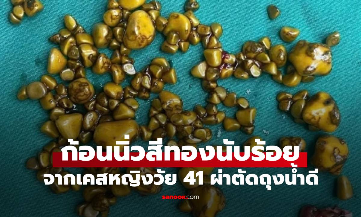 หญิงวัย 41 ผ่าตัดด่วน พบ "ก้อนนิ่ว" สีทองนับร้อยก้อน แวบแรกนึกว่าเมล็ดข้าวโพด