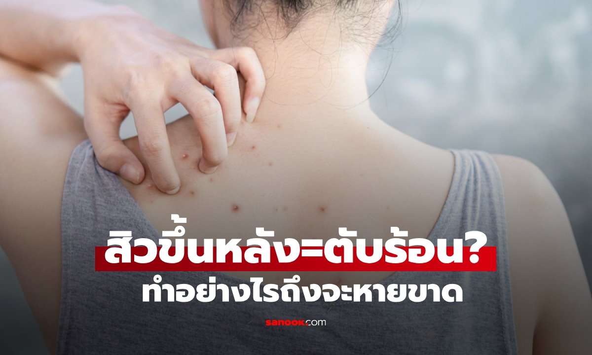 สะอาดแล้วแต่ยังมี  “สิวที่หลัง” เกิดจากตับร้อนใช่ไหม ทำยังไงถึงจะหายขาด?!