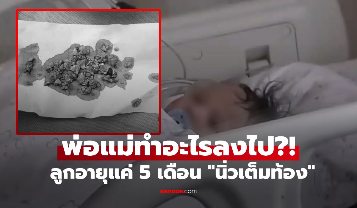 สลด ทารกวัย 5 เดือน "นิ่วเต็มท้อง" แพทย์ยังช็อก รู้ว่าพ่อแม่ให้กินอะไร ตั้งแต่ลูกอายุ 3 วัน!!!