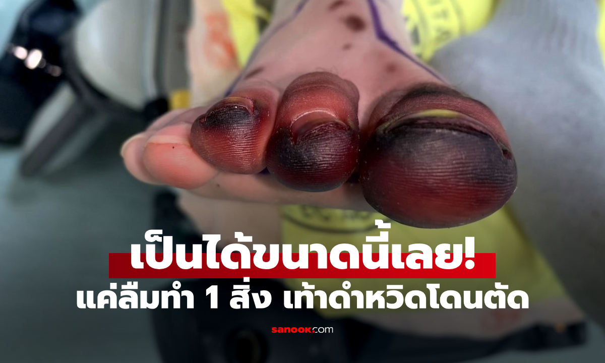 "แม่ของหมอ" ยังไม่รอด! เท้าเปลี่ยนเป็นสีดำ เสี่ยงถูกตัดทิ้ง เพราะลืมทำ 1 สิ่ง ฤดูร้อนยิ่งสำคัญ