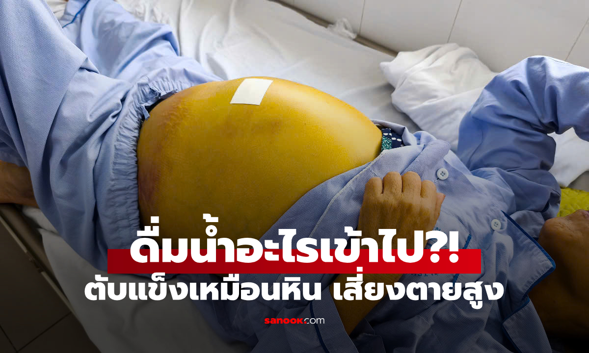 ไม่ใช่เหล้า! หญิงนอนตัวเหลือง "ตับแข็งเหมือนหิน" เซ่นน้ำที่ดื่มเข้าไป แพทย์ชี้เสี่ยงตายสูง