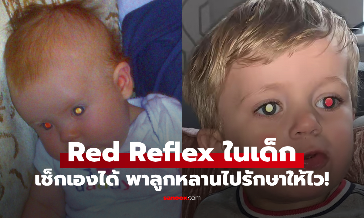 ทดสอบอาการ "Red Reflex" ในเด็ก ถ้าลูกหลานเป็นแบบนี้ รีบพาไปรักษาให้ไว!