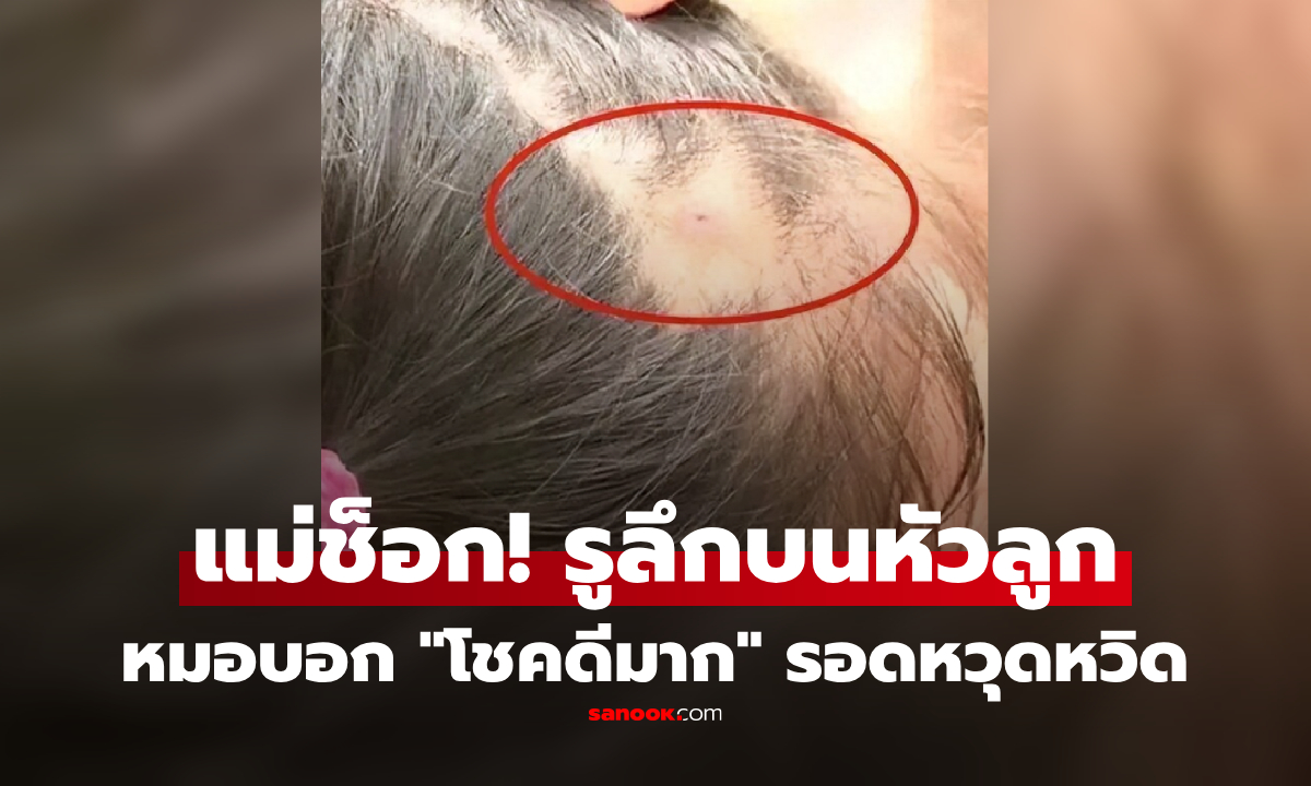 ลูกมีรูบนหัว! แม่ตกใจรีบพาไป รพ. หมอถึงกับบอก &quot;โชคดีมาก&quot; ที่ดึงสิ่งที่ฝังอยู่ออกทัน" width="100" height="100