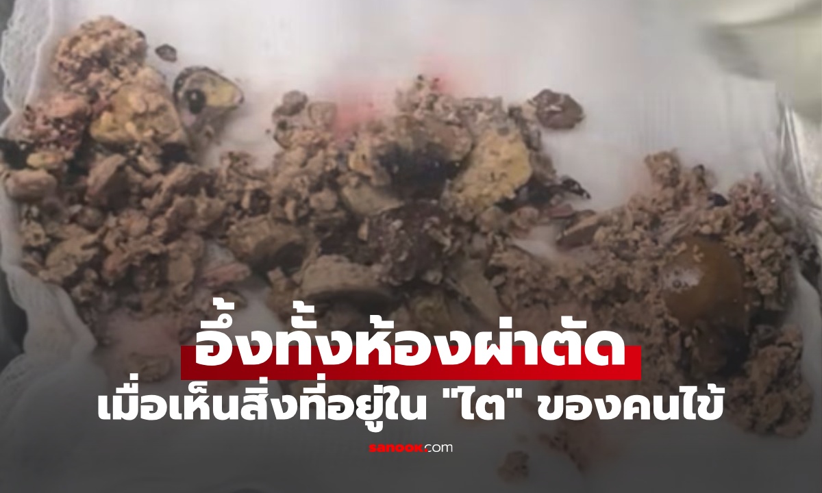 ศัลยแพทย์ยืนอึ้ง เมื่อเห็นสิ่งที่ผ่าตัดออกมาจาก "ไต" คนไข้อดทนอย่างเหลือเชื่อ!