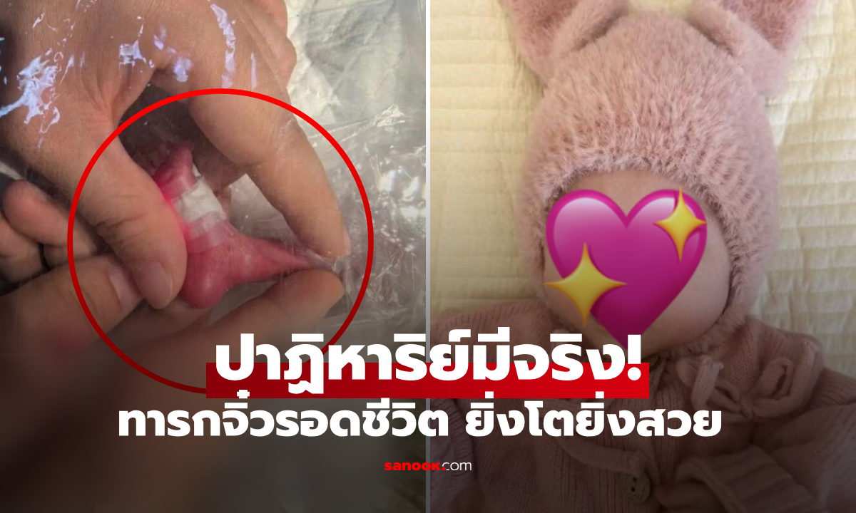 ทารกคลอดมา "ตัวเท่าขวดน้ำ" หนักแค่ 660 กรัม แต่ผ่านมา 3  เดือน สวยเหมือนนางฟ้า!!!