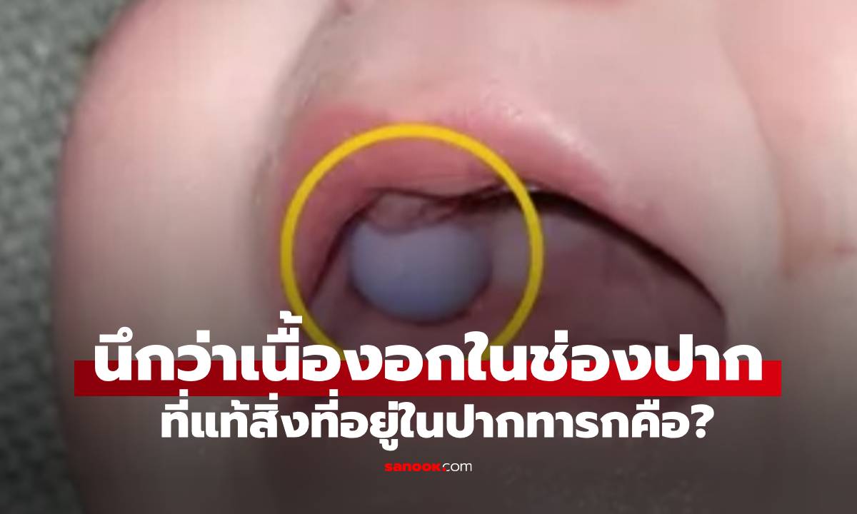 หมอตกใจ คิดว่าทารก 9 เดือน มีเนื้องอกในช่องปาก พอรู้ว่าคืออะไร แม่ช็อกหนัก!
