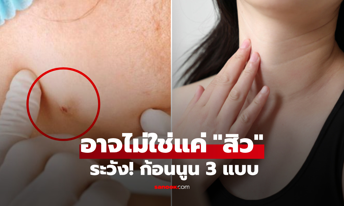 อย่าคิดว่าแค่สิวๆ เตือน "ก้อนนูน" ขึ้นมา 3 แบบนี้ อาจเป็นมะเร็งร้าย ไม่เลือกเพศหรืออายุ!