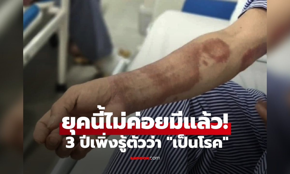 พ่อ-ลูกชายมี "จุดแปลกบนผิวหนัง" นาน 3 ปี หมอตรวจให้ฟรีถึงรู้ เป็นโรคที่ยุคนี้ไม่ค่อยมีแล้ว!