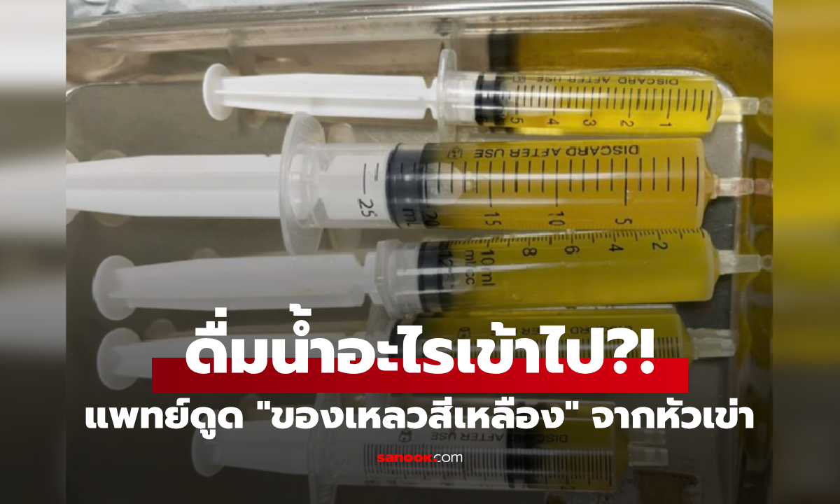 ชายคนหนึ่งถูกดูด "ของเหลวสีเหลือง" ออกจากหัวเข่า 5 กระบอก หลังดื่มสิ่งนี้ไปเพียง 3 แก้ว