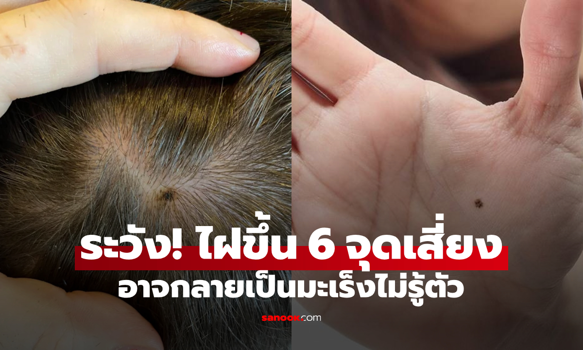 ตรวจเช็กทันที! ไฝขึ้นบนร่างกาย 6 ตำแหน่งนี้ สามารถ “กลายร่าง” เป็นมะเร็งได้ง่ายมาก