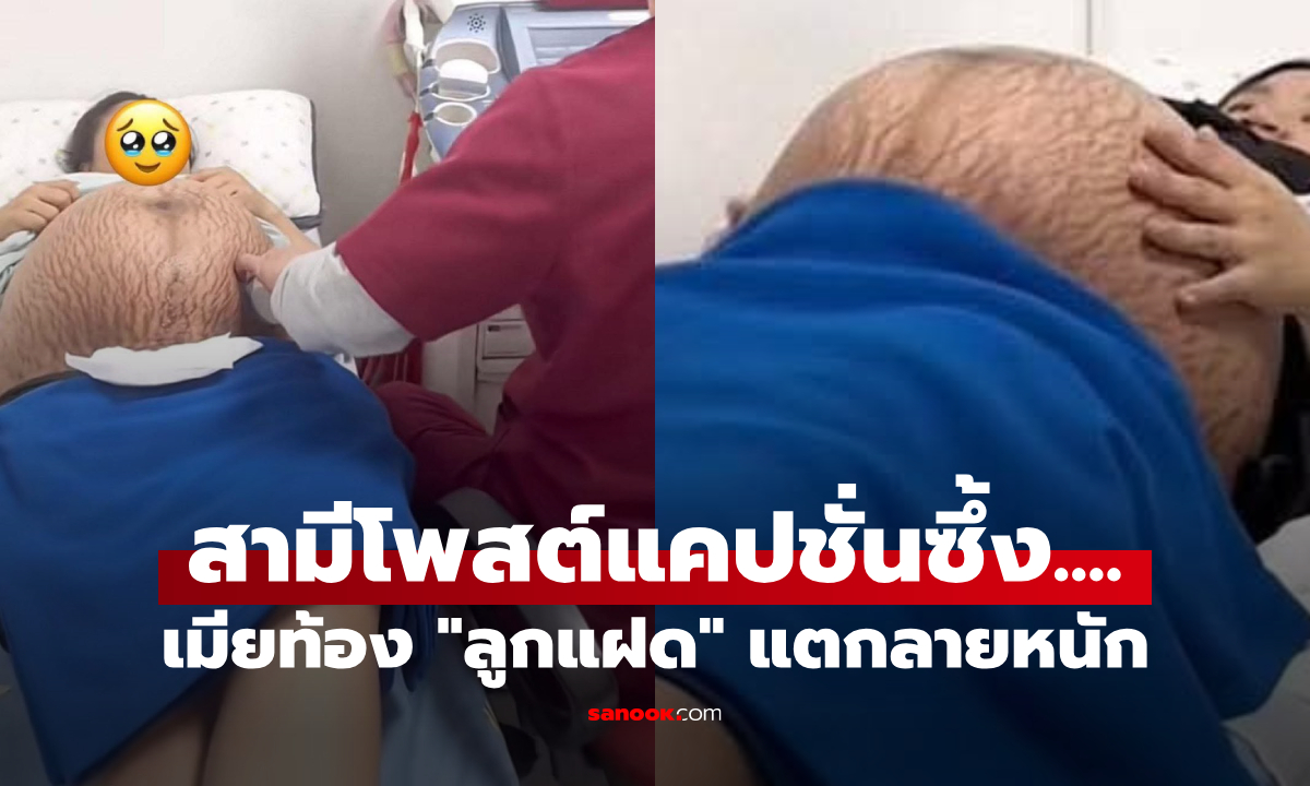 สามีโพสต์ลึกซึ้ง เมื่อเมียตั้งครรภ์ "ลูกแฝด" ทำท้องขยายใหญ่ จนแตกลายเหมือนแตงโม!