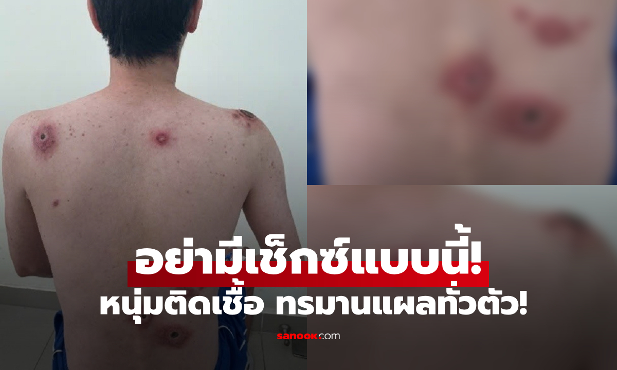 สยอง! หนุ่มออฟฟิศ แผลผุดเต็มตัว แพทย์ชี้มีเซ็กซ์แบบ “ไม่ระวัง” ต้นเหตุความทรมาน